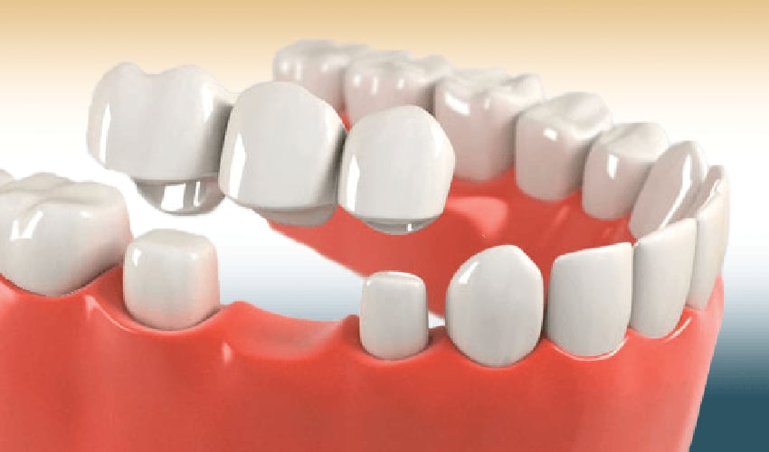 Frequent Challenges Of Dental Crowns