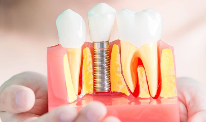 Dental Implants Chandler